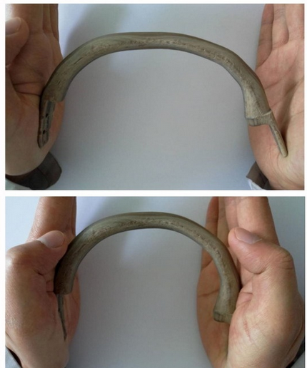 鈦合金將成過去式！我國實施國際首例3D打印PEEK肋骨植入術